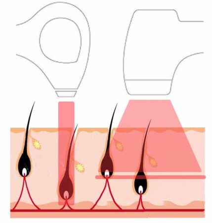 イラスト＿脱毛器　光　深さの違い
